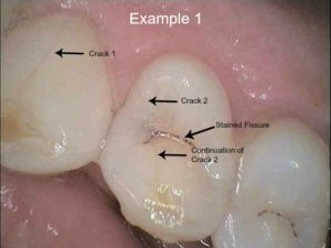 crack tooth 2 labelled