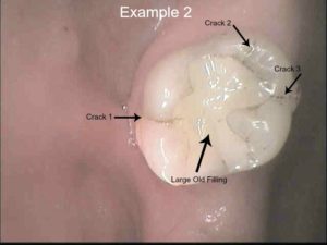 cracked tooth 1 labeled