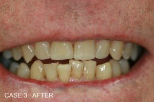 TR After Build Ups to Top Front Teeth