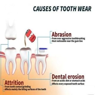 Tooth Wear 1