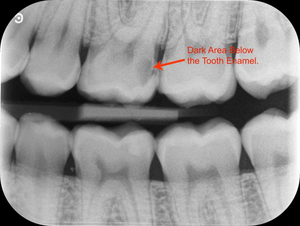 Importance of Dental Xrays Barker Dental Care