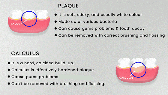 Differentiating Between Plaque and Tartar